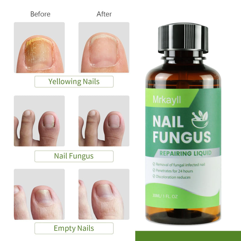 Toenail Fungus Treatment Extra Strength: 7 Pure Natural Plant Extracts，Toe & Fingernail Fungus Renewal - Nail Fungus Treatment Kit with Brush & File - For Ingrown Nails & Discoloration