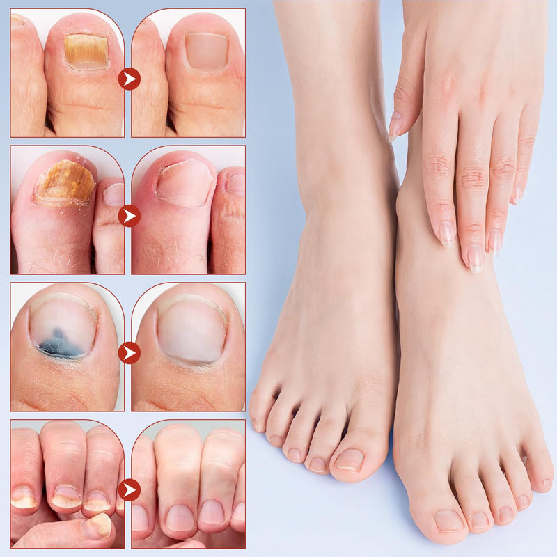 Nail Patches, 8-Hour Overnight Treatment, Fast-Acting Toenail Repair Patches, 21 Patch,for Damaged Nails Foot Nails Repair and Care,Strengthens Brittle Nail (21 Patch*2) 2 PCS