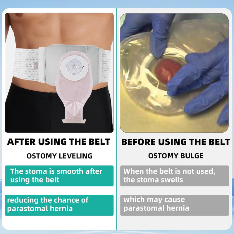 Ostomy Support Belt, Adjustable Stoma Support Belt Medical Ostomy Hernia Belt, Ileostomy Belt, Abdominal Ostomy Hernia Binder Supplies, Universal Ostomy Belt Helps Protection Ostomy Bag(Gray,M) M