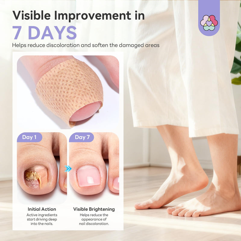 SAVILAND Extra Strength Fungal Nail Patches 96 PCS: 8H Overnight Repair 1% Tolnaftate Toenail Treatment Nighttime Nail Renewal Restores Damaged Nails Discolored Thick Yellow Healthy Appearance 3 Pcs