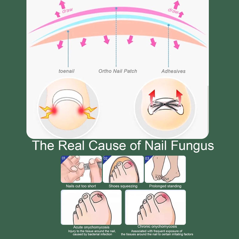 Titanium Alloy Ingrown Toenail Treatment 3X Stronger Pulling Force, Nail Tools and Ingrown Toenail Repair Kit for Curved & Thick Nails, Professional Foot Care Solution for Men & Women (0.63/0.67 in) 0.63-0.67in - BeesActive Australia