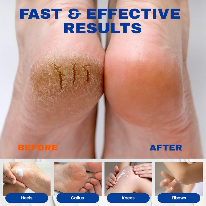 SKIN ULTIMA Urea Cream 40 Percent Plus 2% Salicylic Acid, 40% Urea Cream for Feet Maximum Strength, Foot Cream for Dry Cracked Feet, Heels, Knees, Hands & Elbows, Intensive Repair & Moisture, 5.29 oz Tea Tree 5.29 Ounce (Pack of 1)