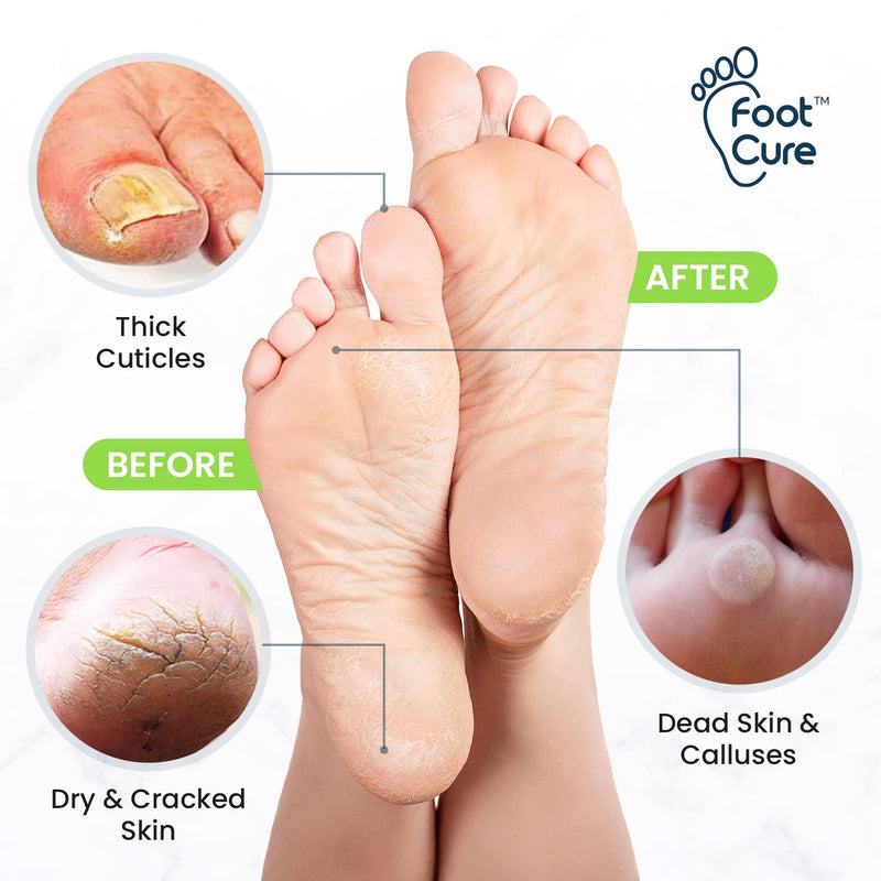 Toenail Fungus Treatment Extra Strength - Best nail fungus treatment for fingernails, nail repair, toenail softener with Toenail repair Solution Complete Pedicure Kit