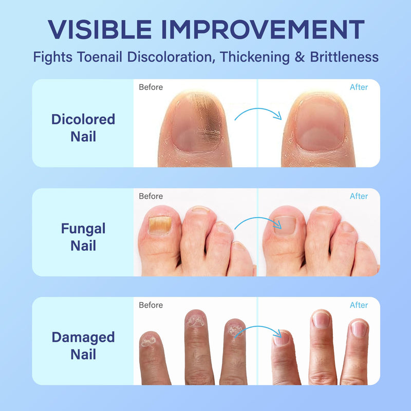 Toenail Fungus Treatment Extra Strength: 25% Undecylenic Acid Toe & Fingernail Fungus Renewal ‚Äì Nail Fungus Treatment Kit with Brush & File ‚Äì For Ingrown Nails & Discoloration 0.5 Fl Oz (Pack of 2) - BeesActive Australia