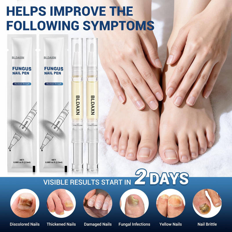 Toenail Fungus Treatment Extra Strength, Fungal Nail Treatment Pen with 25% Undecylenic Acid and 1% Tolnaftate, Maximum Strength Improves Appearance of Discolored, Brittle and Thick Nails (4 Pack) 0.09 Fl Oz (Pack of 4)