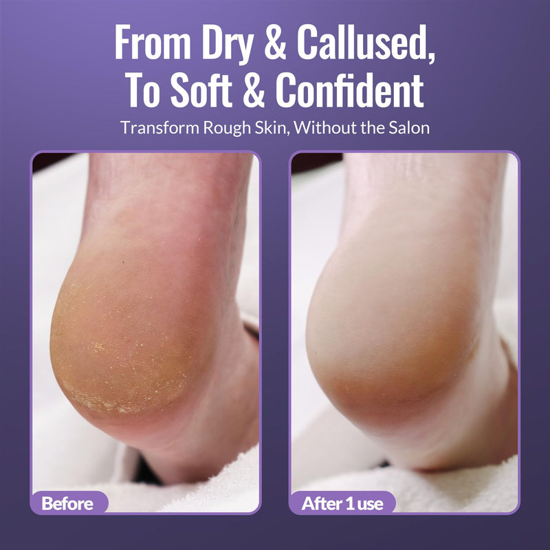 Footlogix Foot Care Callus Softener Combo - Callus Remover Spray & Double-Sided Foot File for Dry, Cracked Heels, Pedicure Tools for Feet, Foot Exfoliator White