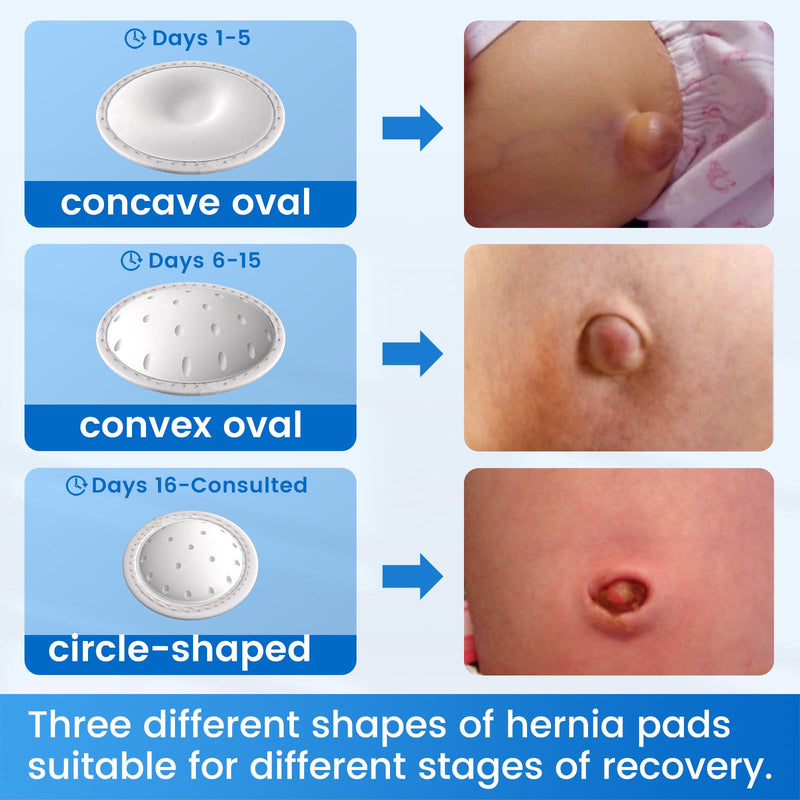 Velpeau Umbilical Hernia Belt Baby Newborn -with 3 Different Shaped Compression Pads, Belly Button Navel Band Wrap Truss Abdominal Binder Support for Infant, Children, Toddler, Kids, One Size < 20" Beige