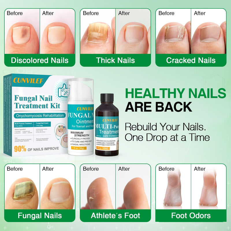 Toenail Fungus Treatment, 25% Undecylenic Acid Nail Repair Liquid 30ML & Clarus Tolnaftate 1% Toenail Fungus Cream 30g Set for Yellow toenails, Damaged Nail treatment extra strength with Tea Tree Oil 1 Fl Oz (Pack of 1)