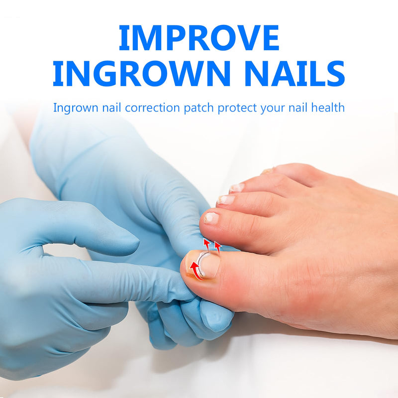 Ingrown Toenail Treatment, Toenail Correction Strips for Curved or Ingrown Nails, Quick Relief, Nail Correction, 5 Different Sizes 1 Count (Pack of 1)