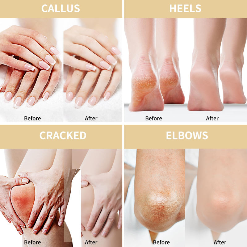 Urea Cream 50 Percent for Feet 10.58 oz with Oat and 2% Salicylic Acid, Foot & Hand Cream included Hyaluronic Acid, Tea Tree and Aloe Vera for Deep Moisturizing, Callus Removing (Upgraded Formula) Oat-Mild 10.58 Ounce (Pack of 1) - BeesActive Australia