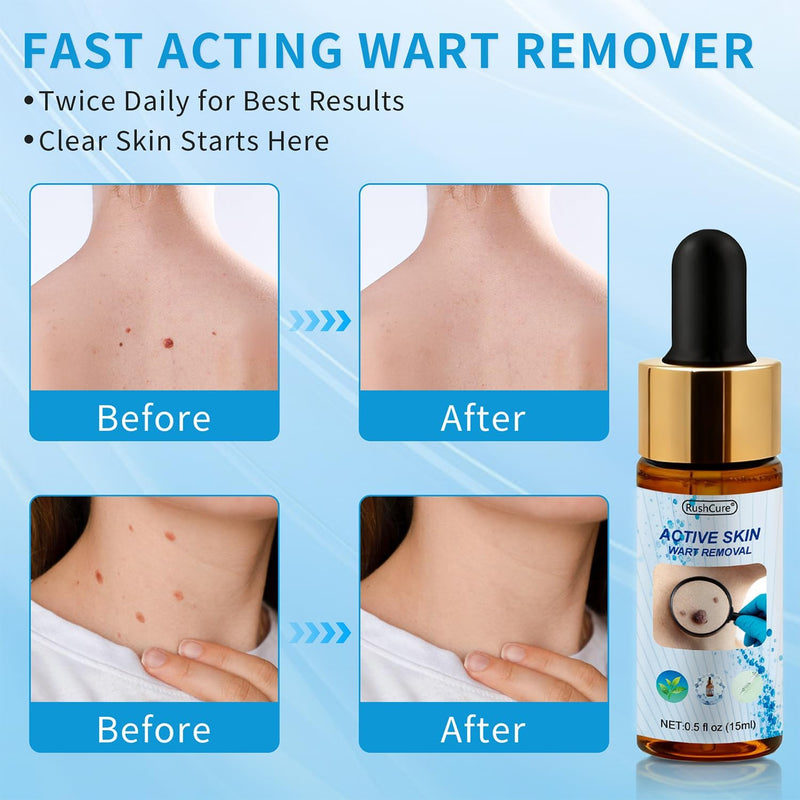 Natural Wart Oil Liquid Drops – Fast, Safe for Kids, Maximum Strength Wart Ointment with Pure Essential Oils – No Pain, No Scarring, Easy to Use on Face, Neck, Body, Hands, Feet