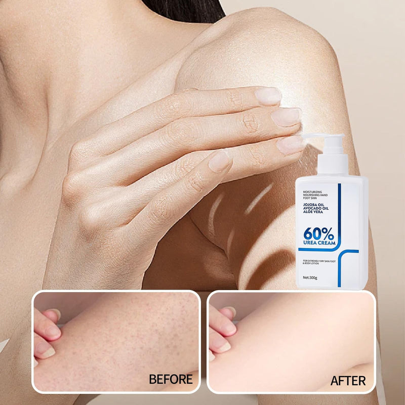 Urea Cream 60 Percent Body Lotion 10.58 Oz, Body Lotion for Dry Skin, Skin Moisturizing Lotion for Extremely Dry Skin, Non Greasy Body Cream