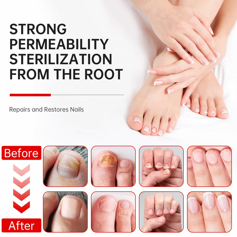 Nail Fungus Treatment Extra Strength - 25% Undecylenic Acid, Gentle Plant Formula for Fingernails, Treats Under & Around Nail, Treatment Discoloration, Repair Thick, Damaged Nails, 2.02Fl.oz 2.02 Fl Oz (Pack of 1)
