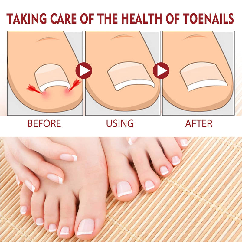Nail Fungus Treatment Gel, Nail Fungus Treatment Cream,Multi-Purpose Nail Repair Oil Serum (2pcs) 2pcs