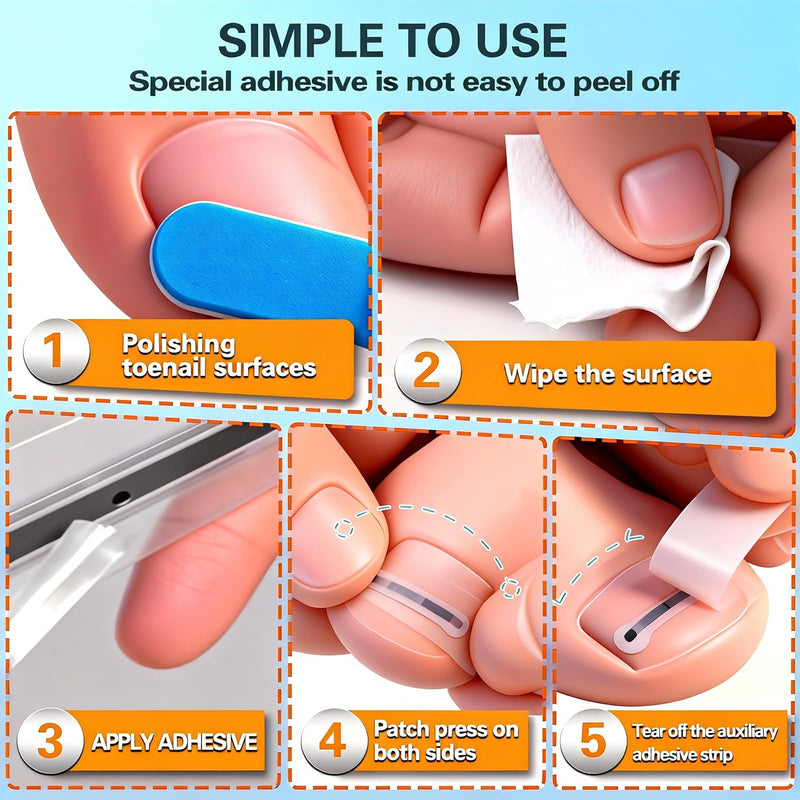 Titanium Alloy Ingrown Toenail Treatment - Professional Home Care for Curved Nails - Waterproof, Nail Tools and Ingrown Toenail Removal Kit,Ingrown Toenail Corrector(0.59/0.67in) Blue