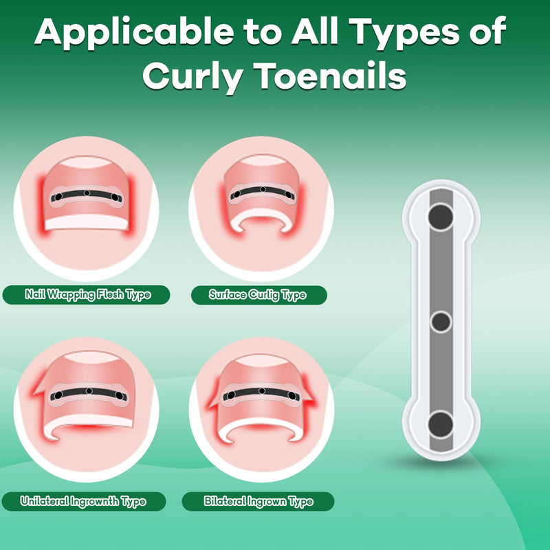 Titanium Alloy Ingrown Toenail Corrector New Version Ingrown Toenail Removal Tool Kit, Designed for Curved Nail Repair Big Toe Ingrown Toenail - BeesActive Australia