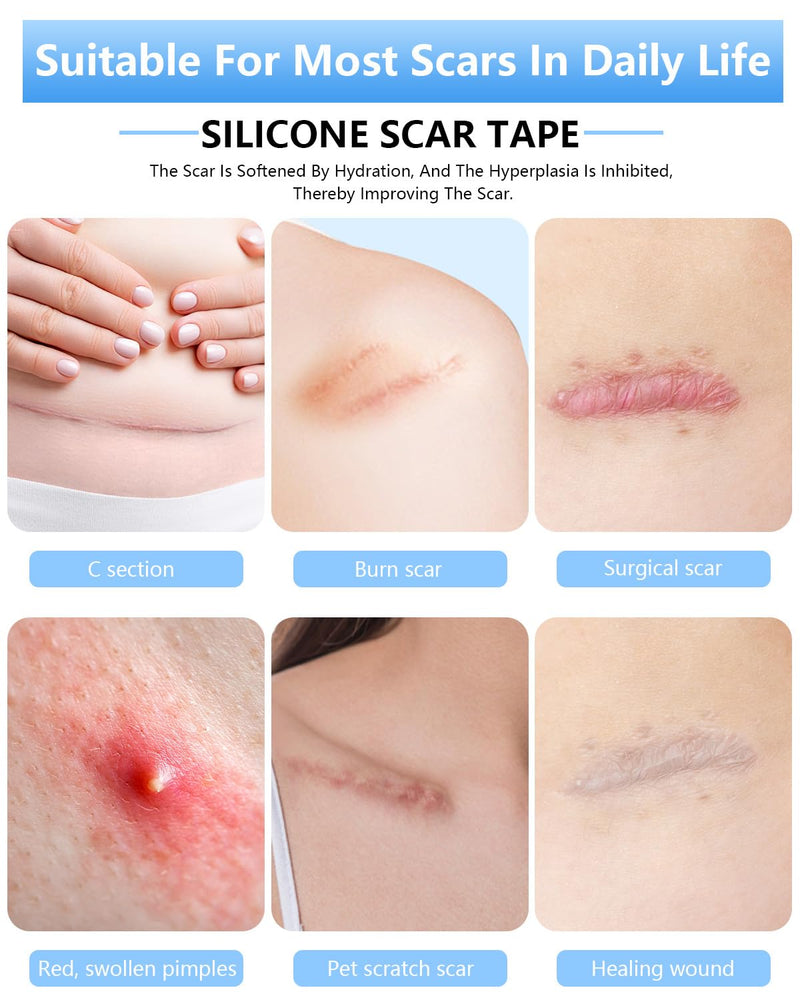 Silicone Scar Sheets, Silicone Scar Tape, 1.6‚Äùx60‚Äù Roll, Scar Removal Treatment, Medical Grade Scar Tape for Surgical, C-Section, Burn Scars (1.5M) 1.5M - BeesActive Australia