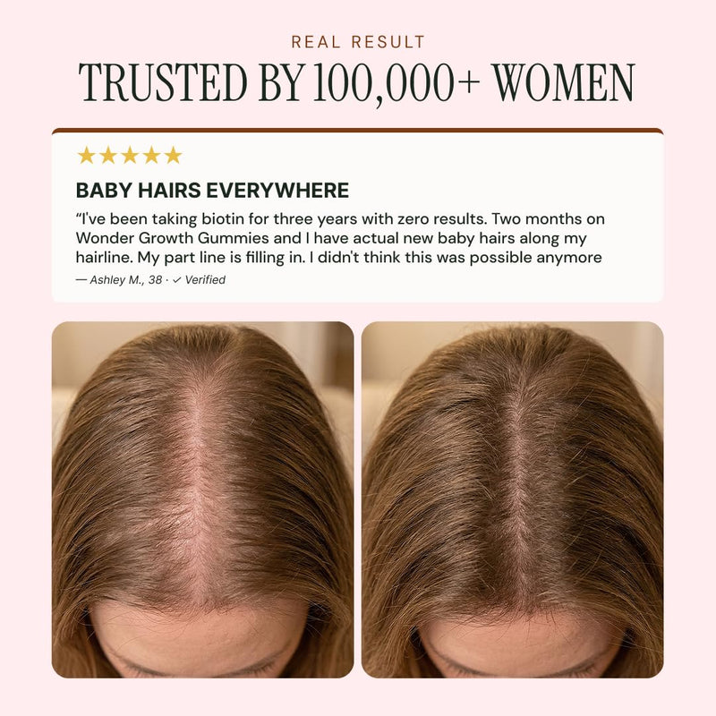 NOOR HAIR Wonder Growth Gummies for Women - Natural Hair Growth Supplement with Folate, B12, Biotin, & Zinc. Supports Hair Regrowth, Thicker Hair. Reduced Shedding - 1 Month Supply