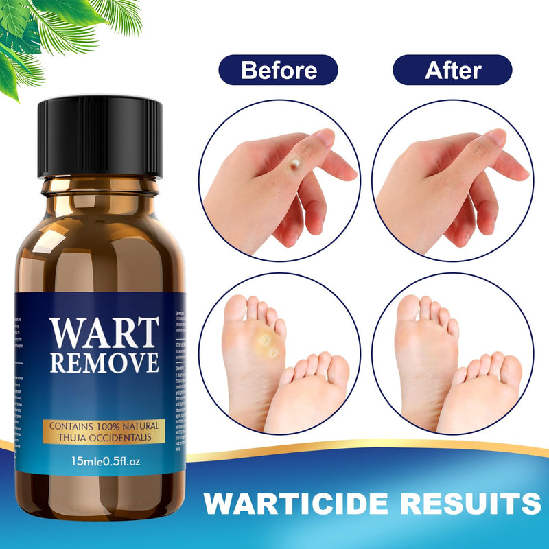 Fast Action Liquid Wart Remover - Maximum Strength Wart Gel - Exclusive Natural Formula Wart Liquid Designed for Warts, Plantar Wart, Genital Wart, Common Wart, Flat Wart, Corn, Callus Beige - BeesActive Australia