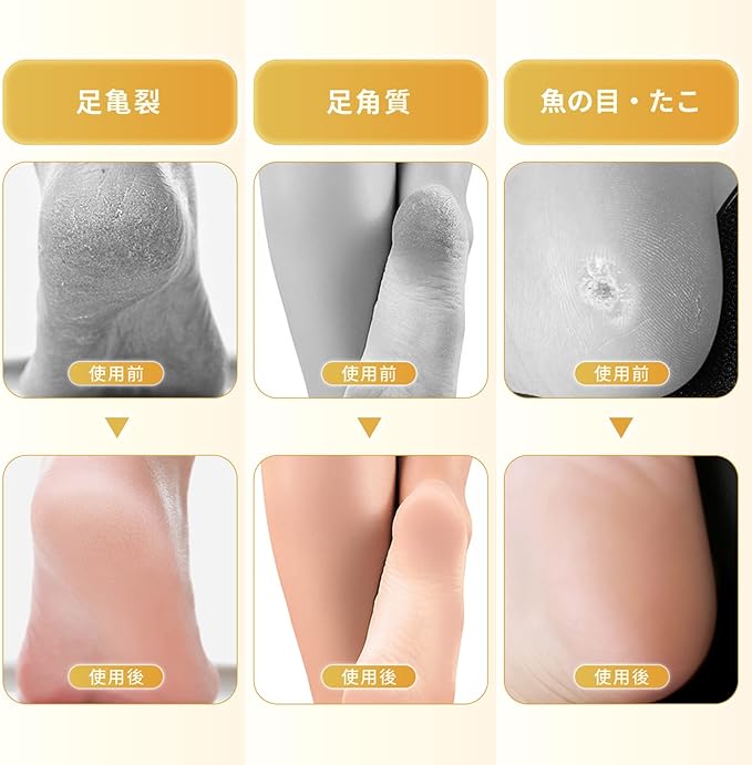 Annhua Natural Pumice Stone, Keratin Care, Volcanic Stone, Foot Care Tool, Washable, Reusable Use, Unisex, Smooth Heels, Skin Care, Heel Sharpening, Foot Massage, Promotes Circulation, Foot Pumice, Bath Stone, Foot Care Set, White -  Australia
