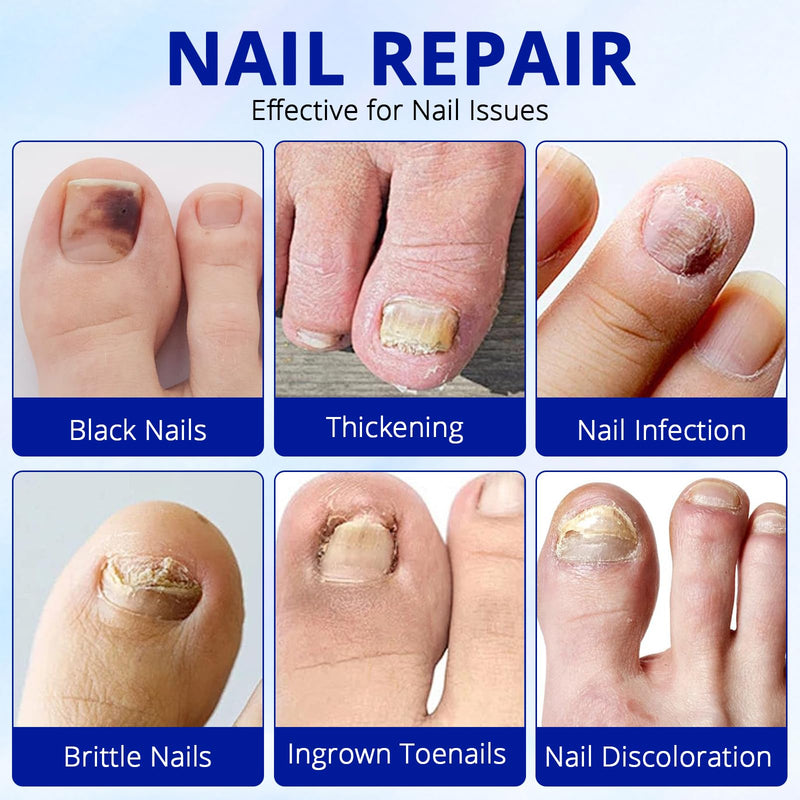 Fungal Nail Patches-Toenail Fungus Treatment Extra Strength, Toe Nail Fungus Treatments, Overnight Hydrogel Nail Care Patches, Nail Repair, Easy To Apply, 42Pcs, For Men & Women,HUIzhijia2pack - BeesActive Australia