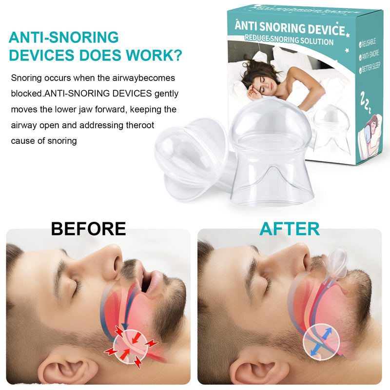 Snoring Solution, Tongue Retaining Snore Devices Stopper - Anti Snoring Devices Mouthpiece Mouth Guard for Men and Women - RS10 White Large - BeesActive Australia