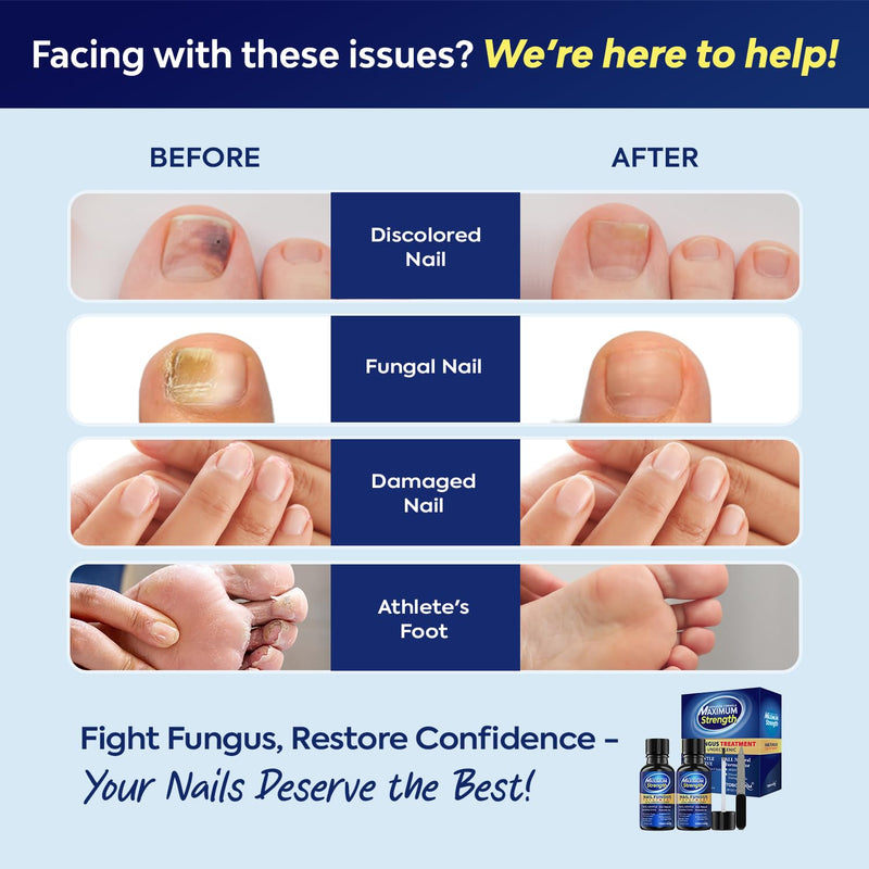 Toenail Fungus Treatment with 25% Undecylenic Acid, Toe Fungus Treatment for Toenail, Fungus Nail Treatment, Toenail Fungus Treatment Extra Strength, Fungal Nail Treatment for Athletes Foot - 2pcs - BeesActive Australia