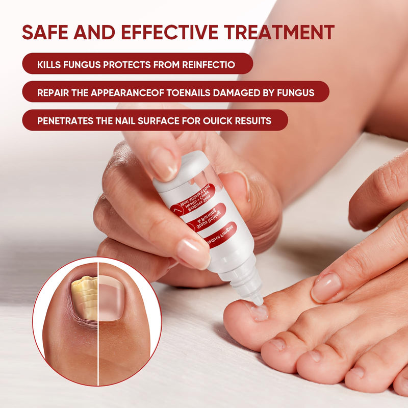 Toenail Treatment,Gentle Formula, Effectively Improves Nails for a More Beautiful Appearance 0.5 Fl Oz (Pack of 2) - BeesActive Australia