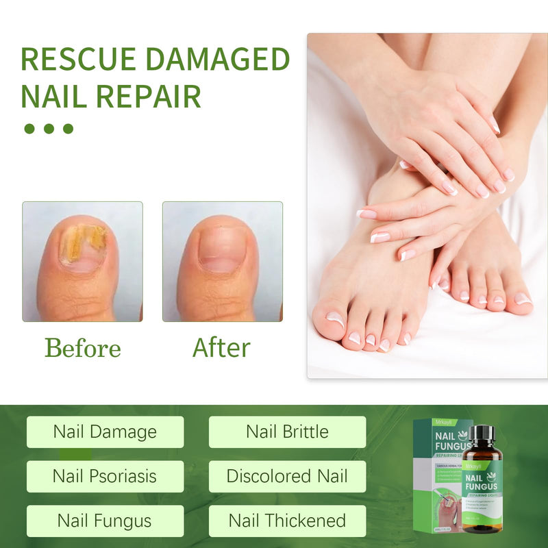 Toenail Fungus Treatment Extra Strength: 7 Pure Natural Plant Extracts，Toe & Fingernail Fungus Renewal - Nail Fungus Treatment Kit with Brush & File - For Ingrown Nails & Discoloration