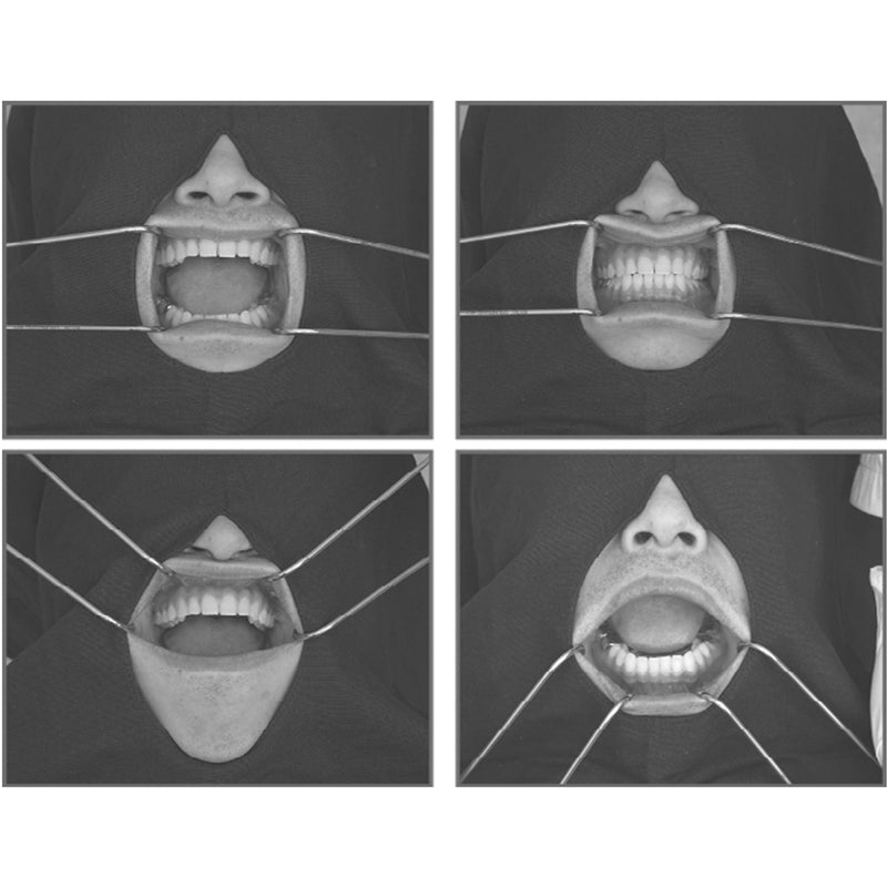 OSUNG Dental Columbia Cheek Retractor Autoclavable Mouth Opener Stainless Steel Instrument Teeth Whitening RTCRC 2 pc set