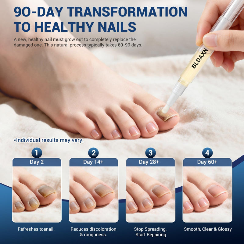 Toenail Fungus Treatment Extra Strength, Fungal Nail Treatment Pen with 25% Undecylenic Acid and 1% Tolnaftate, Maximum Strength Improves Appearance of Discolored, Brittle and Thick Nails (4 Pack) 0.09 Fl Oz (Pack of 4)