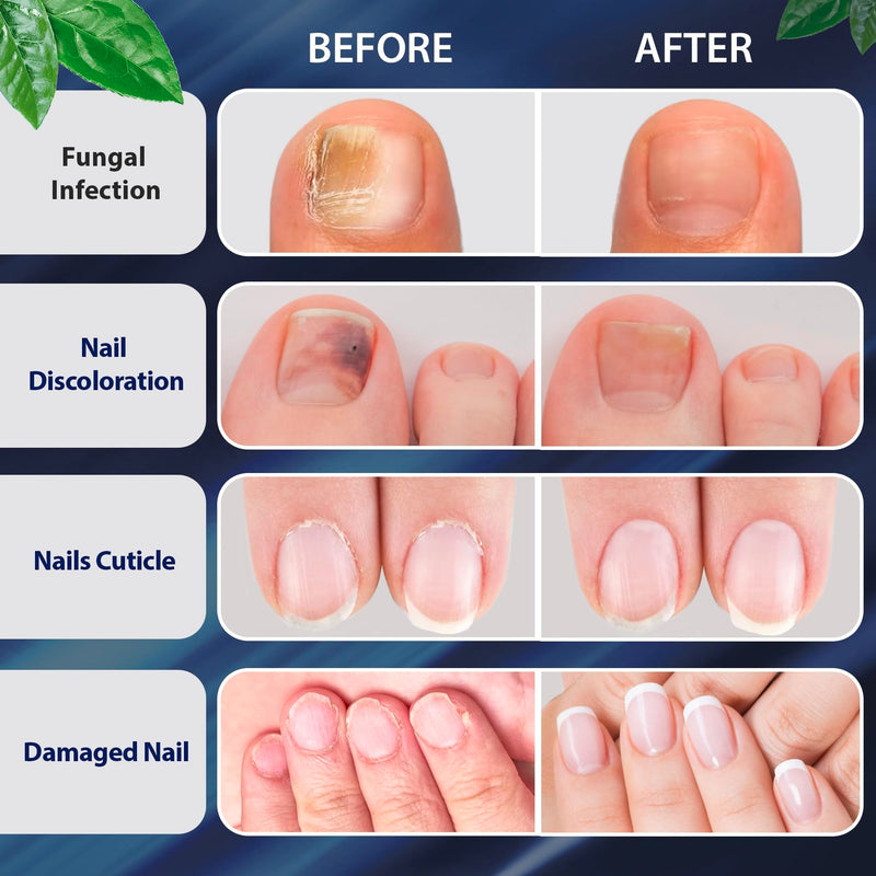 Tobcharm Toenail Fungus Treatment : Nail Fungus Treatment Extra Strength with Tea Tree Oil - Fast Acting Fungal Nail Solution with Undecylenic Acid for Toenails and Fingernails (2pack, 1.02fl oz each) Fresh Herbal 1.03 Fl Oz (Pack of 2) - BeesActive Australia