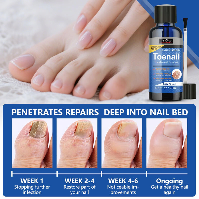 Toenail Fungus Treatment Extra Strength, Nail Fungus Treatment with 25% Undecylenic Acid, Upgraded Fungal Nail Repair for Yellow, Discolored, Thick and Ingrown Nails, 2 Bottles