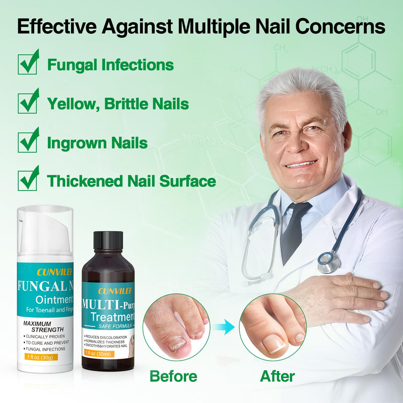 Toenail Fungus Treatment, 25% Undecylenic Acid Nail Repair Liquid 30ML & Clarus Tolnaftate 1% Toenail Fungus Cream 30g Set for Yellow toenails, Damaged Nail treatment extra strength with Tea Tree Oil 1 Fl Oz (Pack of 1)