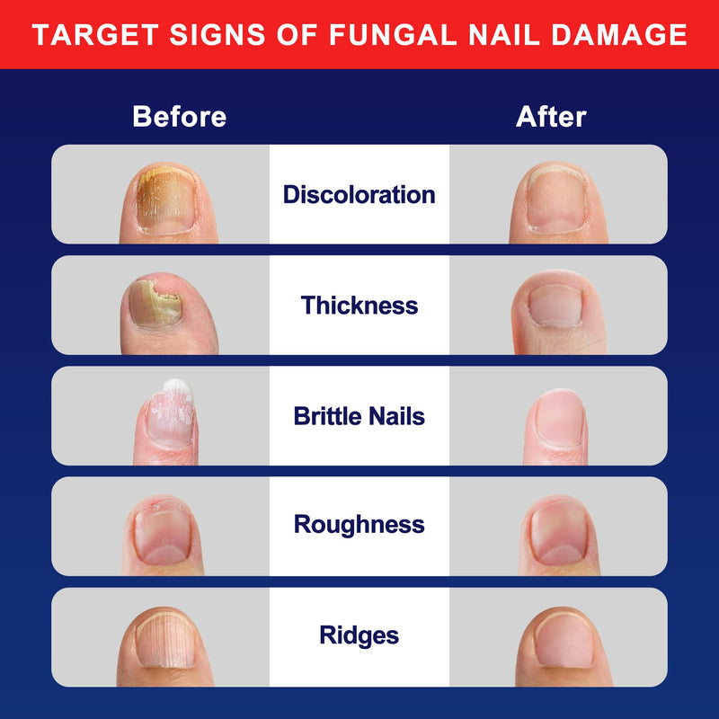 Toenail Fungus Pen - Toenail Fungus Treatment Extra Strength Renewal Kit for Thick, Broken & Discolored Toenails & Fingernails 0.1 Fl Oz (Pack of 6)
