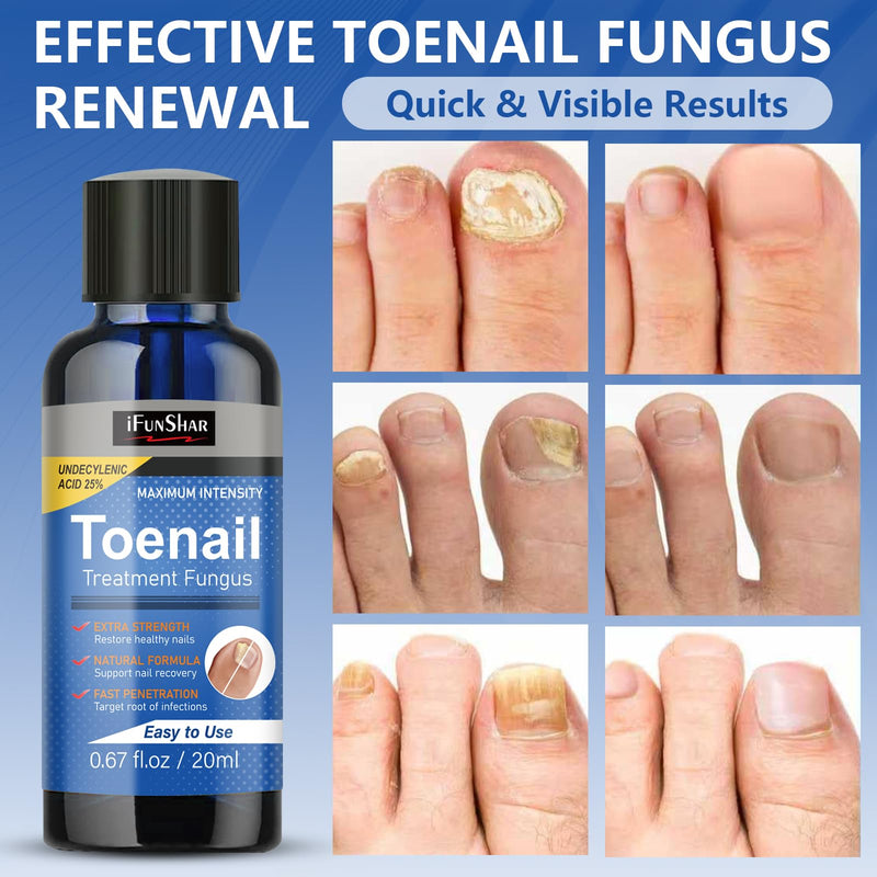 Toenail Fungus Treatment Extra Strength, Nail Fungus Treatment with 25% Undecylenic Acid, Upgraded Fungal Nail Repair for Yellow, Discolored, Thick and Ingrown Nails, 2 Bottles