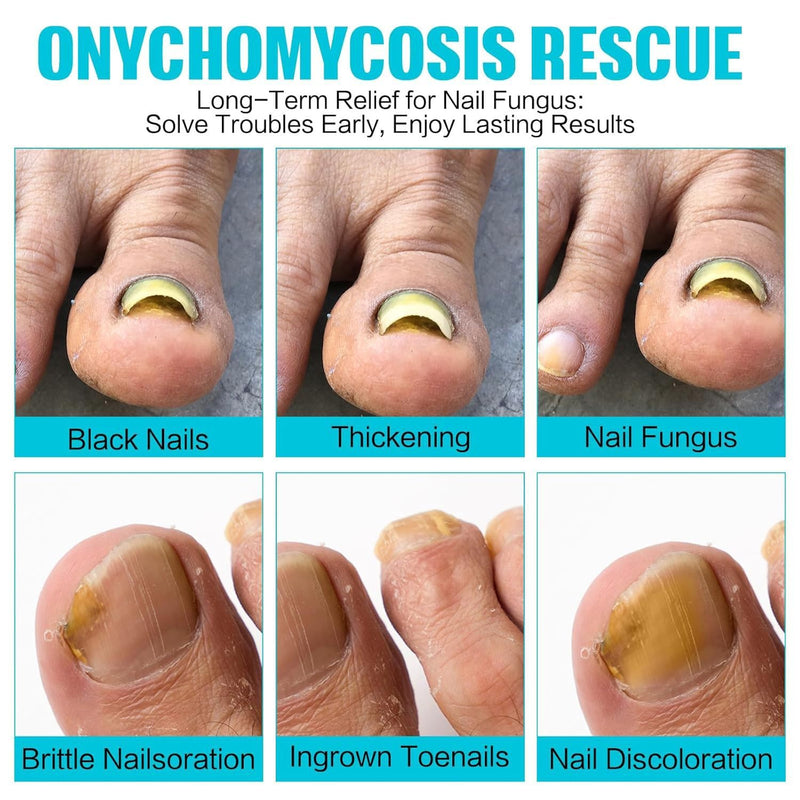 Fungal Nail Treatment Patches, 21 Pieces, Professional Nail Care Solution