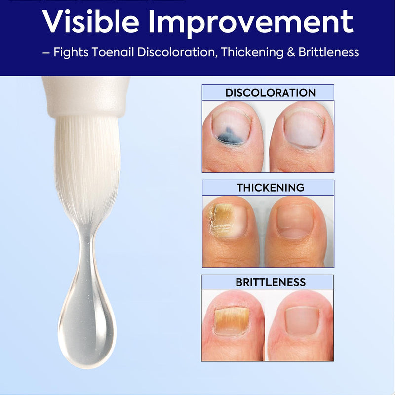 Nail Fungus Treatment Extra Strength: 25% Undecylenic Acid Formula - Toenail Fungus Treatment Kit with 5 Pens & Nail File for Ingrown Nails, Discoloration & Brittle Nails 0.1 Fl Oz (Pack of 5)