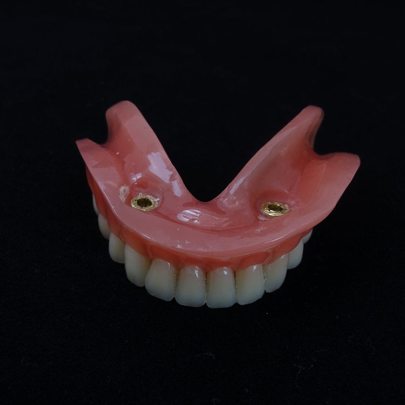Dental Model Overdenture Inferior 2 Implants Demo for Studing and Teaching