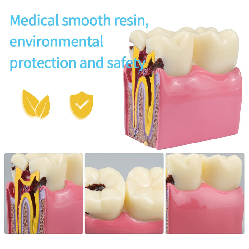 ANNWAH Dental Caries Teeth Model,Dental Anatomy Education Tooth Model,6 Times Caries Teaching Typodont Tool for Dentists, Patients, Teachers and Students - BeesActive Australia