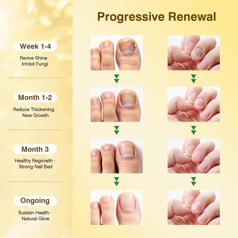 Toenail Fungus Treatment Extra Strength - Nail Repair for Damaged Nails, Nail Repair with 25% Undecylenic Acid & Tolnaftate, Toenail Fungus Treatment for Fungal Toenail Fingernails & Athletes Foot - BeesActive Australia