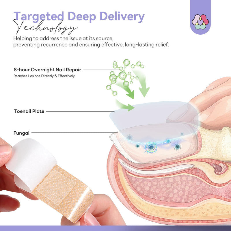 SAVILAND Extra Strength Fungal Nail Patches: 8H Overnight Repair 1% Tolnaftate Toenail Treatment Nighttime Nail Renewal Restores Damaged Nails Discolored Thick Yellow Healthy Appearance 32PCS