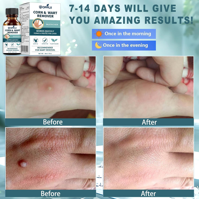 Wart Remover, Fast-Acting Removal for Men and Women,Strongest Wart Removal for Toes Feet - Exclusive Formula 17% Salicylic Acid Freeze Off for Plantar,Common, Flat Wart, 30ml - BeesActive Australia