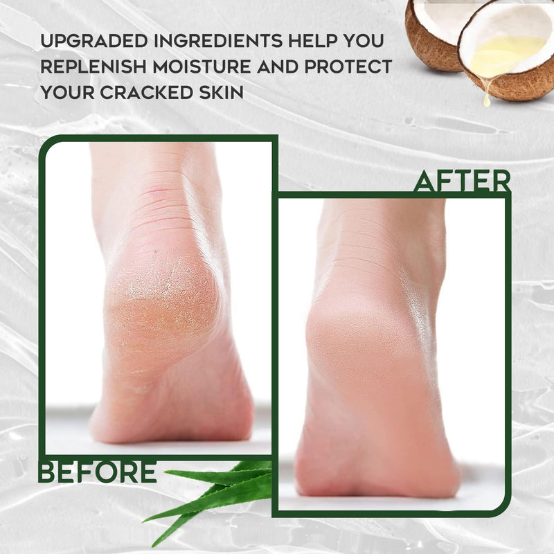 Urea Cream 42% Foot Cream Salicylic Acid 4 Oz, Upgraded Callus Remover For Feet, Knees& Elbows, Intensive Moisturizes & Softens Skin, Exfoliates Dead Skin - BeesActive Australia