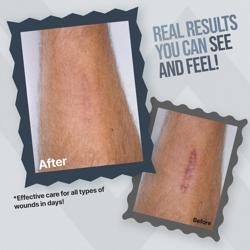 WoundWorx Silver Wound Dressing Gel for Burns, Abrasions, Cuts, Ulcers, Surgical Sites - Non-Toxic, Unscented, Alcohol-Free - No Stinging, No Burn - Patented 32PPM Silver Technology - 1.5oz Tube