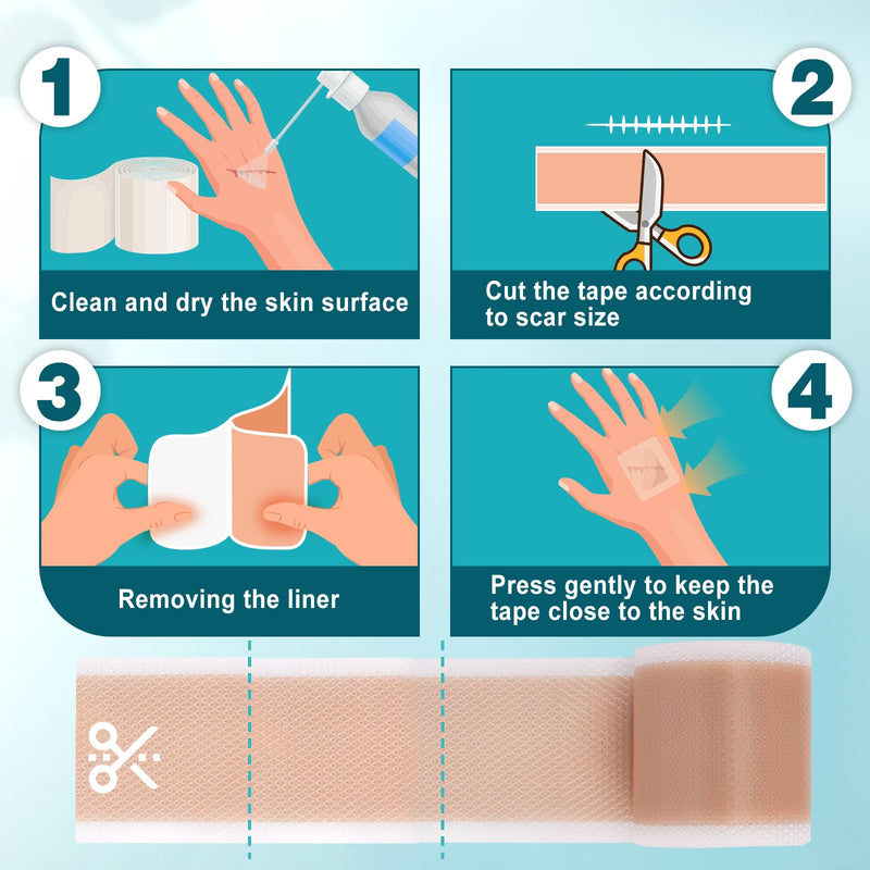 Arme Silicone Scar Tape, 1.6"x480" Silicone Scar Sheets(4 Rolls-12M) Medical Grade Scar Tape for Surgical Scars, Reusable Scar Patches, Professional Scar Removal Strips for C-Section Keloid Tummy Tuck 480" - 12M (4 Rolls)
