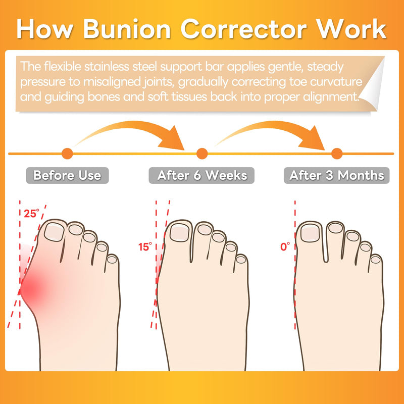InhwRior Bunion Corrector with 4 Flexible Stainless Steel Strips (2 on Each Side), Silicone Pads for Cushioning, Pain-Free Foot Condition Improvement, Wearable with Shoes,Washable