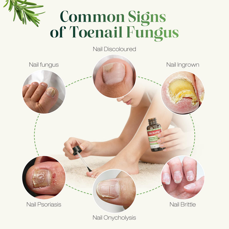 Toenail Fungus Treatment Extra Strength - Nail Repair for Damaged Nails, Nail Fungus Treatment Extra Strength with 25% Undecylenic Acid & Tea Tree Oil, Nail Repair for nail fungus treatment