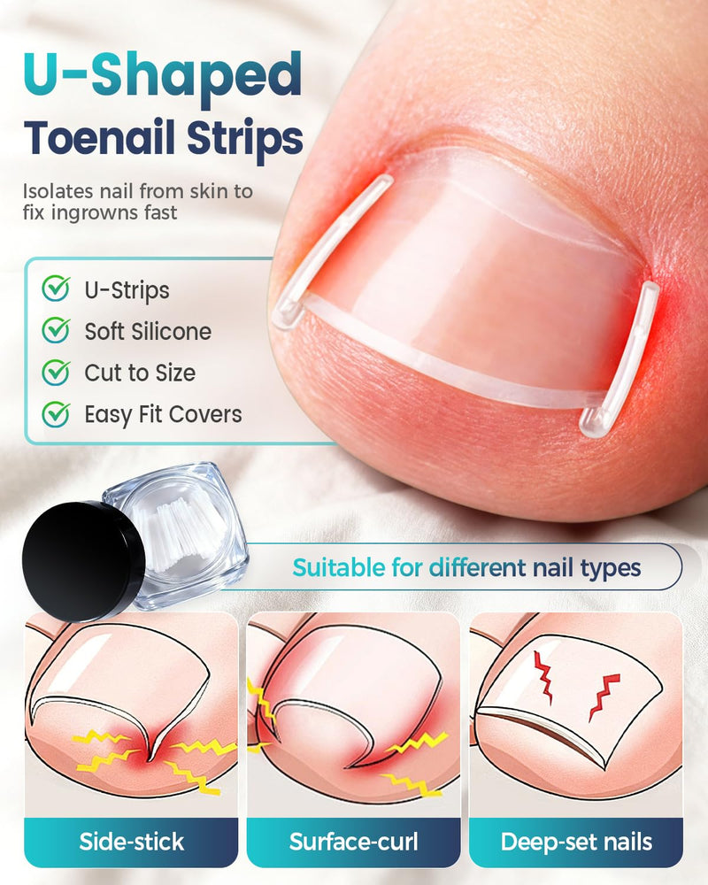 Professional Ingrown Toenail Corrector, 2-in-1 Ingrown Toenail Removal Kit with U-Shaped Strips and Correction Patch, Ingrown Toenail Clippers Tool Set- Effective Removal of Ingrown Toenails (Silver) Silver - BeesActive Australia