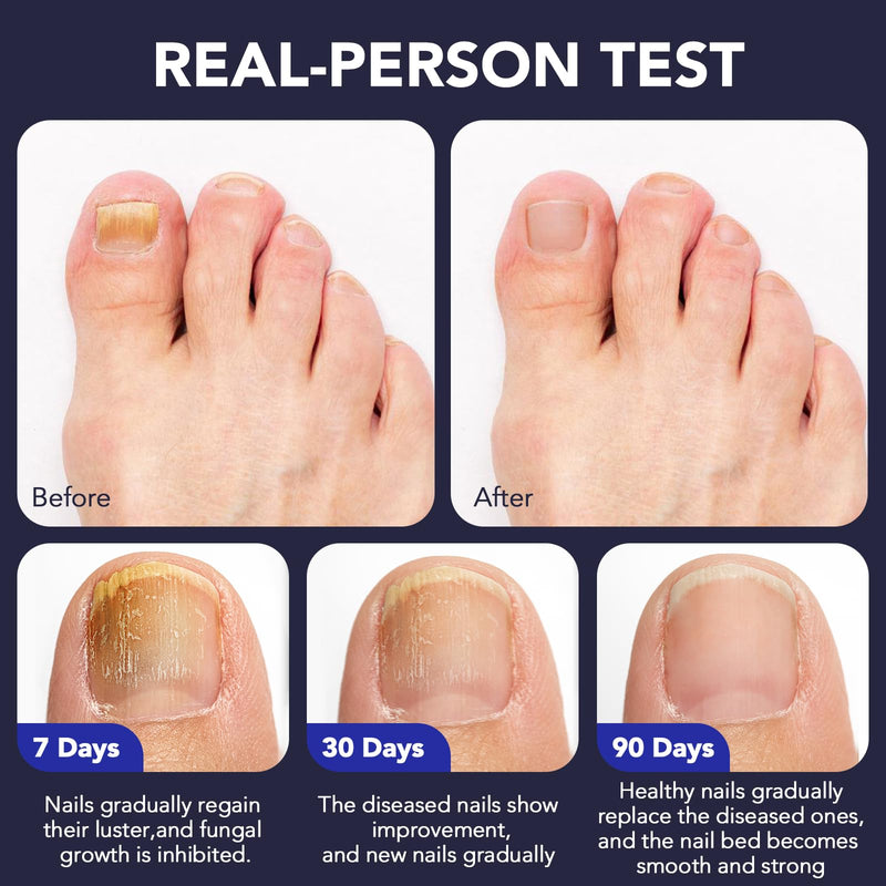 Toenail Fungus Pen - 25% Undecylenic Acid, Tea Tree Oil - Toenail Fungus Treatment Extra Strength for Toe Nail Repair Pen for Damaged Nails, Foot Fungal Nail Treatment for Fungi Funginail - 5pcs - BeesActive Australia